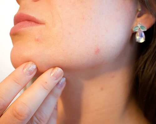 acne-pores-skin-pimple
